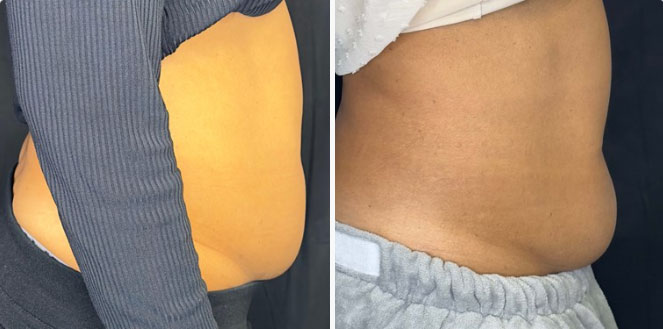 Nonsurgical Body Contouring