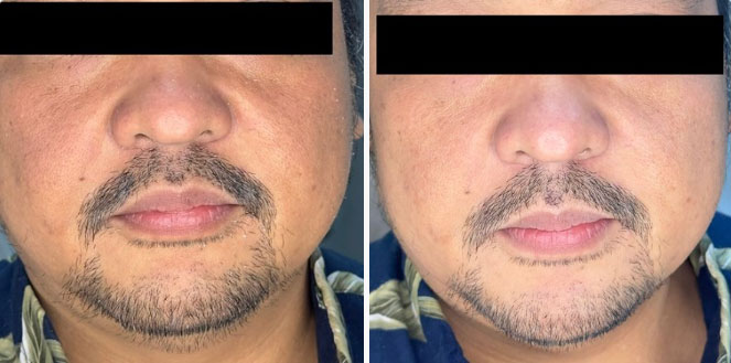 Glo2Facial by Geneo